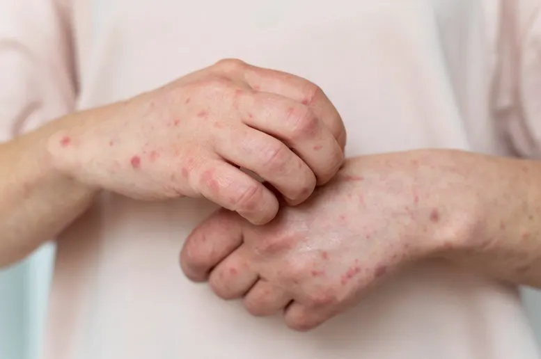 Skin Infections